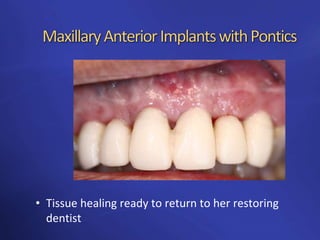 Anterior implants building the foundation | PPTX