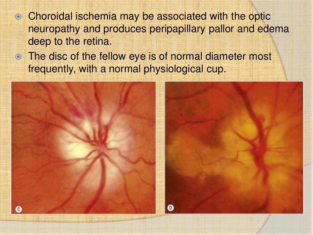 Anterior ischemic optic neuropathy