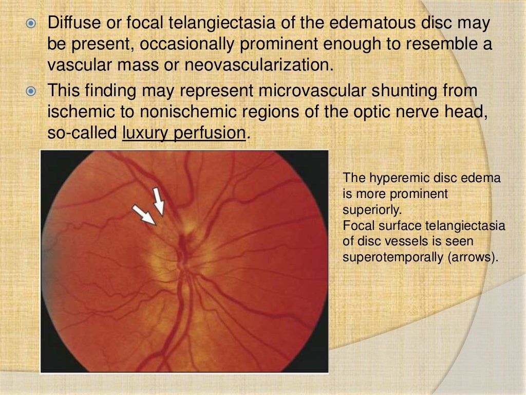 Anterior ischemic optic neuropathy
