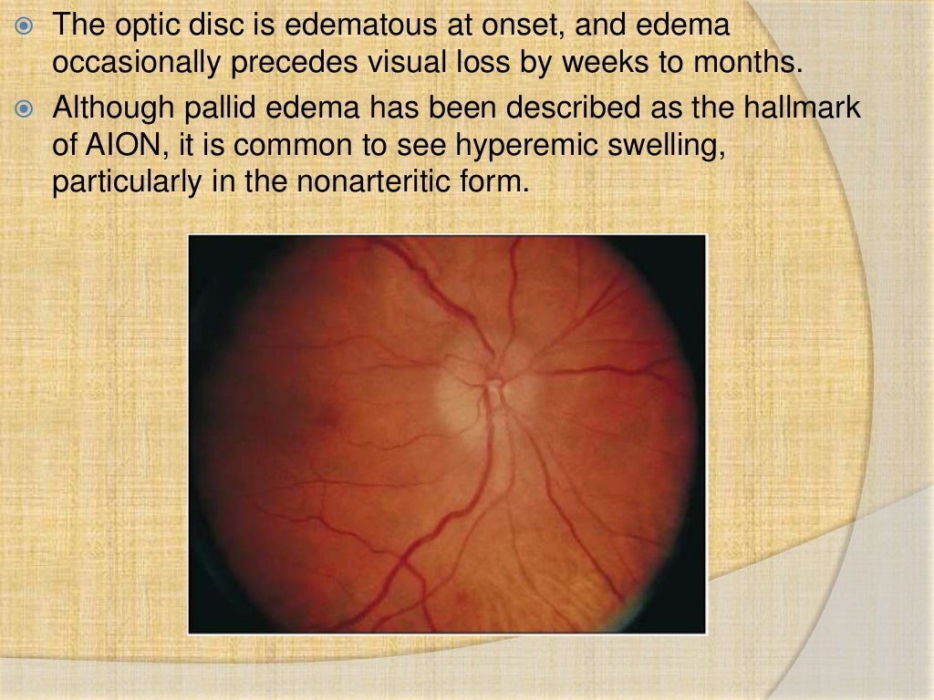Anterior ischemic optic neuropathy