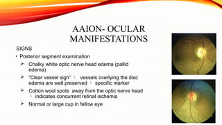 Anterior ischemic optic neuropathy.pptx