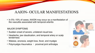 Anterior ischemic optic neuropathy.pptx