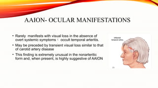 Anterior ischemic optic neuropathy.pptx