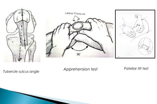 

Apprehension sign of Fairbanks



Patellar tilt test - retinacular contracture or laxity



Passive and Active latera...