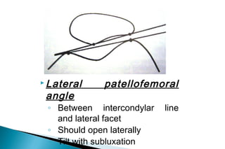 

Patellofemoral index
◦
◦

M - closest distance between articular ridge
and medial condyle
L - closest distance between ...