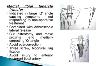 Proximal quadriceps plasty
 Indication

‘Q’ angle is normal or has been
corrected but patella remain subluxated
laterally...