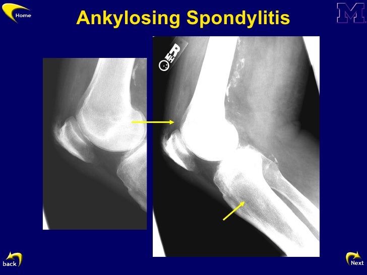Anterior Knee Pain By Dr. Brian Sabb