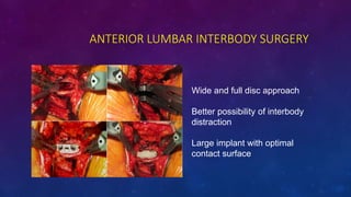 ANTERIOR LUMBAR INTERBODY SURGERY
Wide and full disc approach
Better possibility of interbody
distraction
Large implant wi...