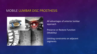MOBILE LUMBAR DISC PROSTHESIS
All advantages of anterior lumbar
approach
Preserve or Restore Function
(Mobility)
Limiting ...