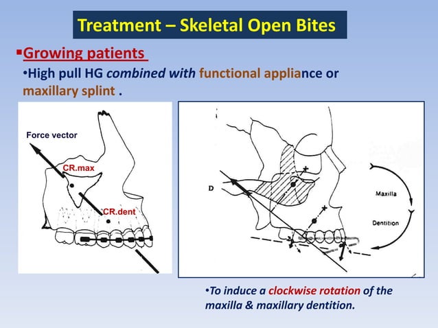 Anterior open bite treatment deciduous and mixed dentition .slide | PDF ...