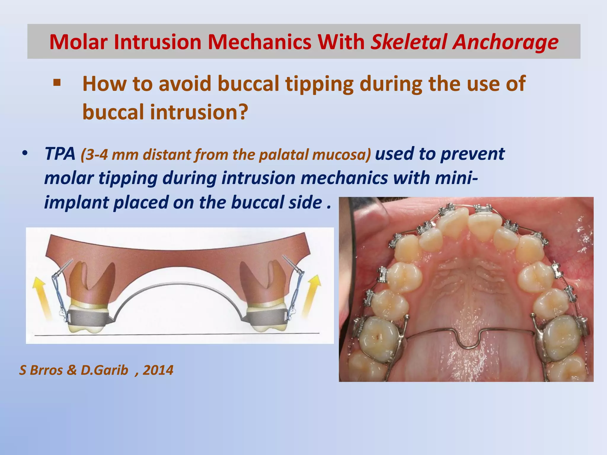 Anterior open bite treatment in the permanent dentition part 2- | PDF