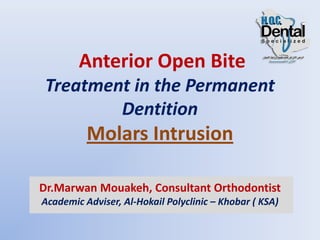Anterior Open Bite
Treatment in the Permanent
Dentition
Molars Intrusion
Dr.Marwan Mouakeh, Consultant Orthodontist
Academic Adviser, Al-Hokail Polyclinic – Khobar ( KSA)
 