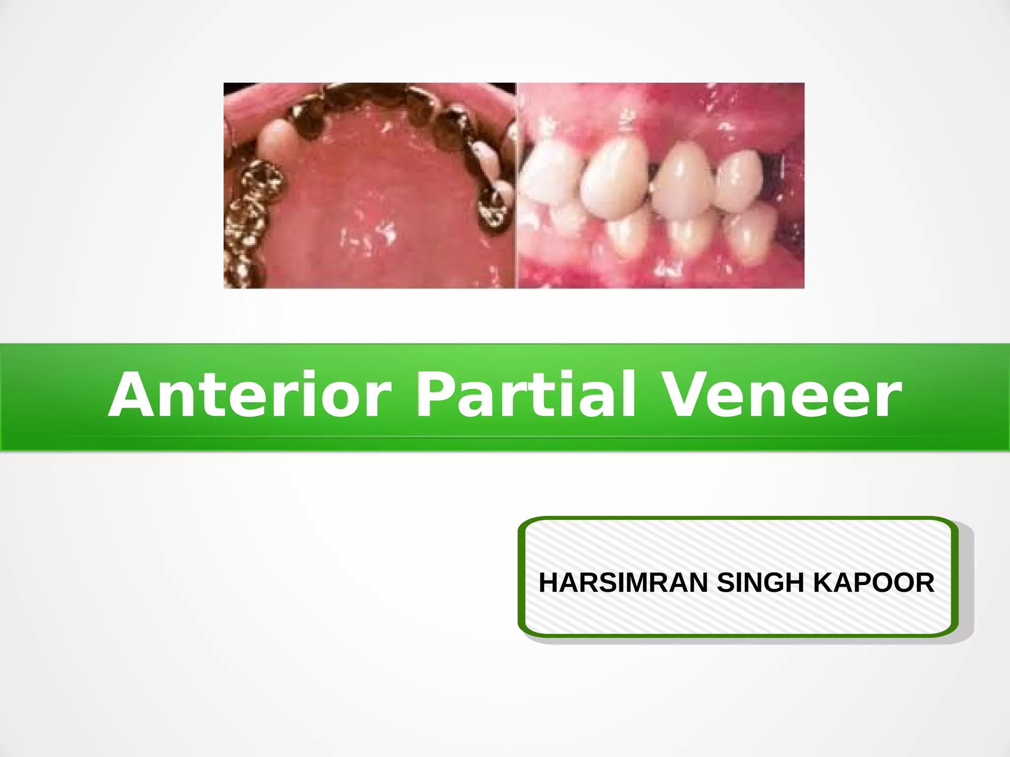 Anterior Partial Veneer crown preparation PPT