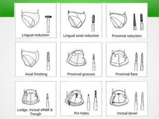 Pin Ledge Anterior Partial Veneer crown preparation | PDF