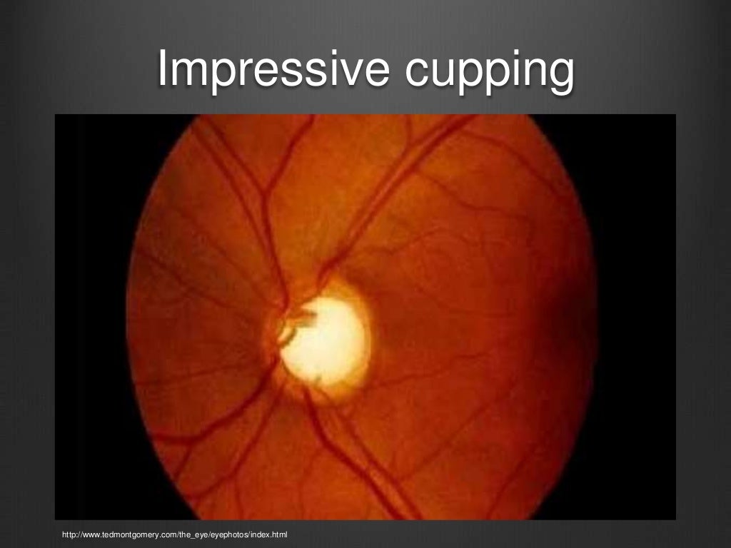 Anterior Pole Dr. Scott Burdette