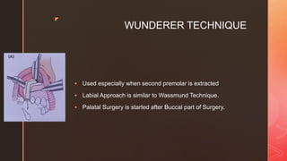 z
WUNDERER TECHNIQUE
 Used especially when second premolar is extracted
 Labial Approach is similar to Wassmund Technique.
 Palatal Surgery is started after Buccal part of Surgery.
 