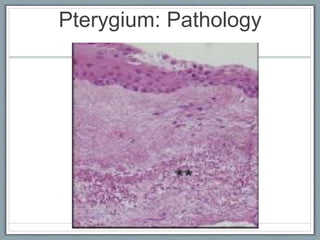 Pterygium Histology