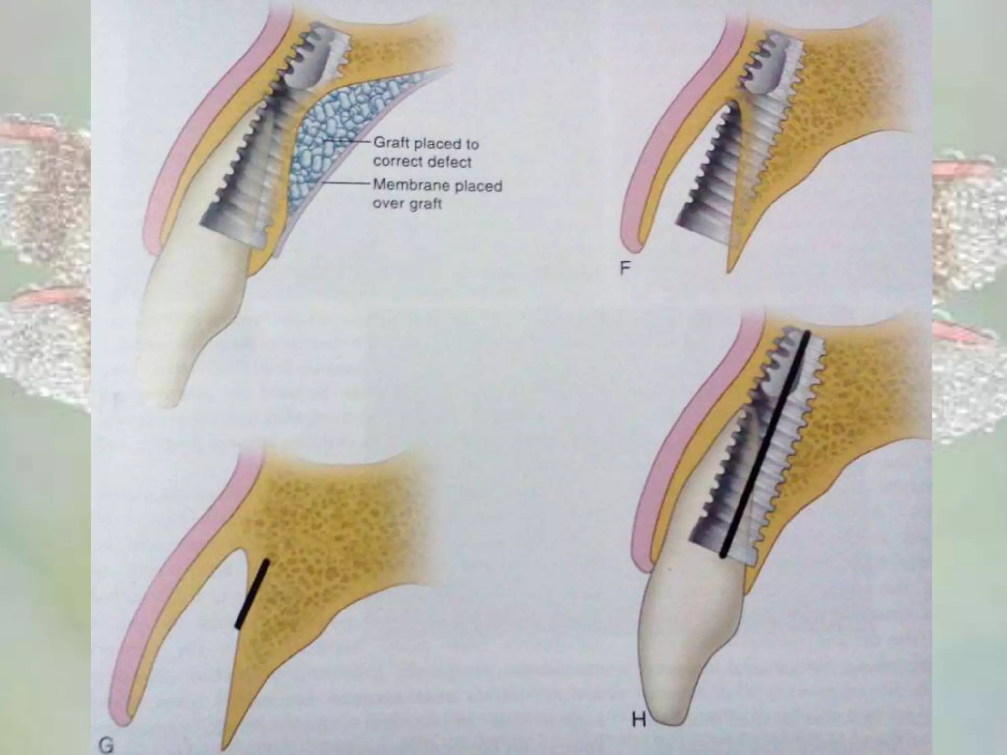 Anterior Single Tooth implants in the Esthetic Zone | PPTX