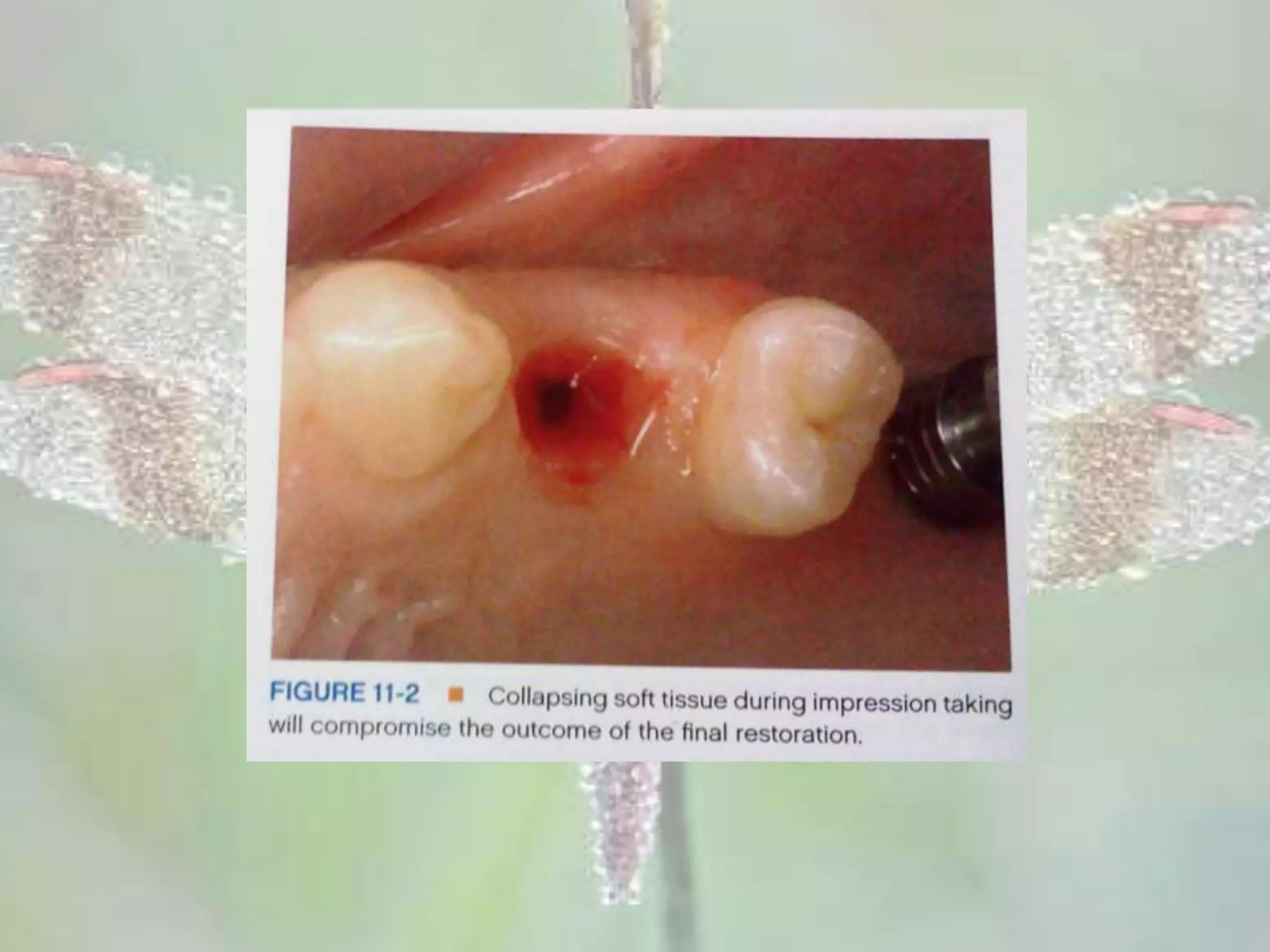 Anterior Single Tooth implants in the Esthetic Zone | PPTX