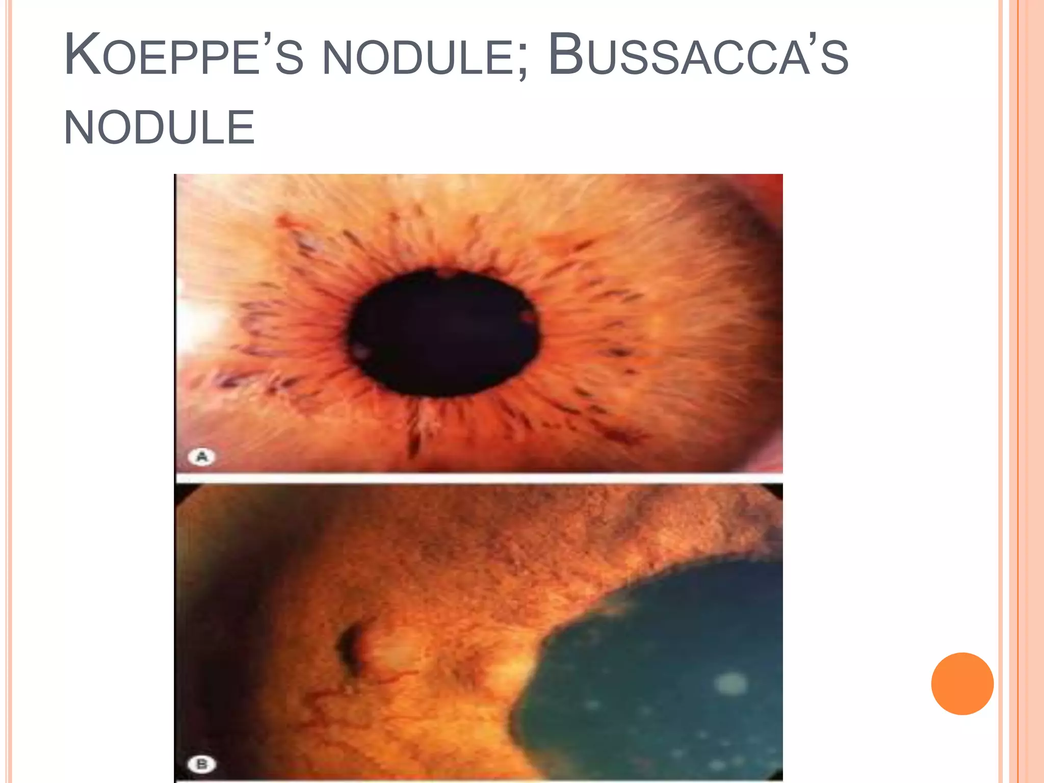 Anterior uveitis | PPTX