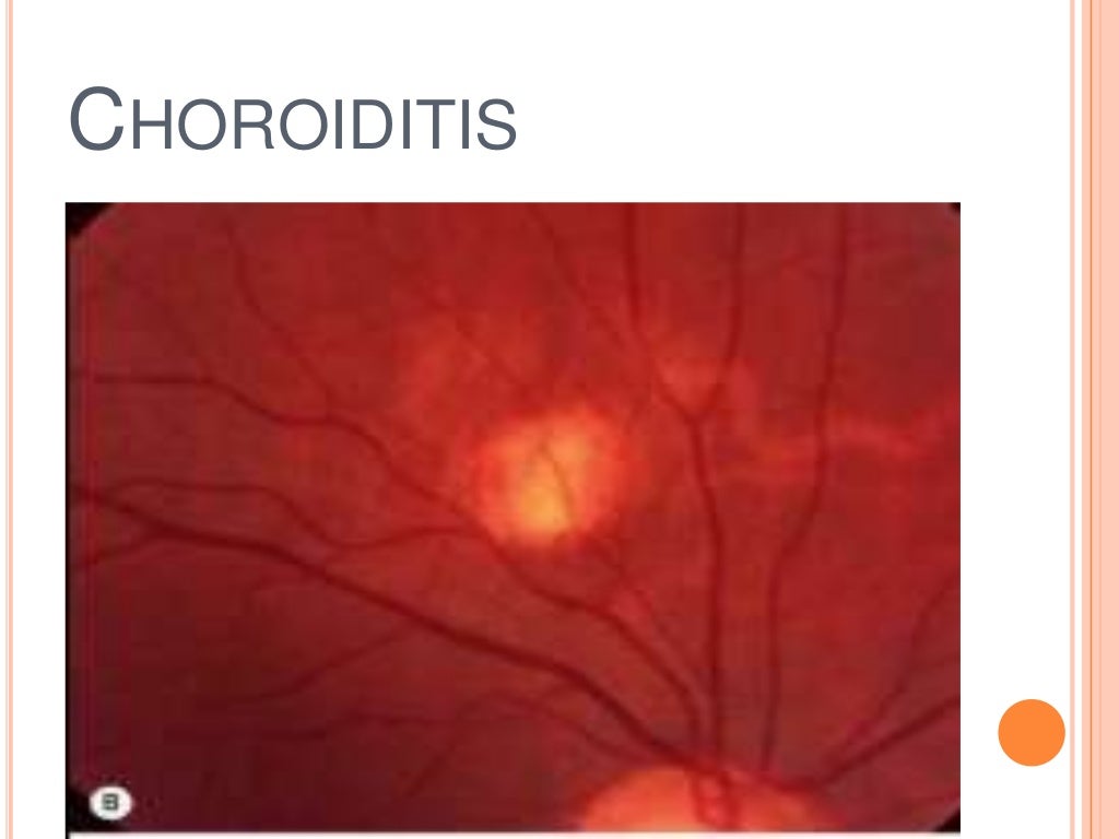 Anterior uveitis