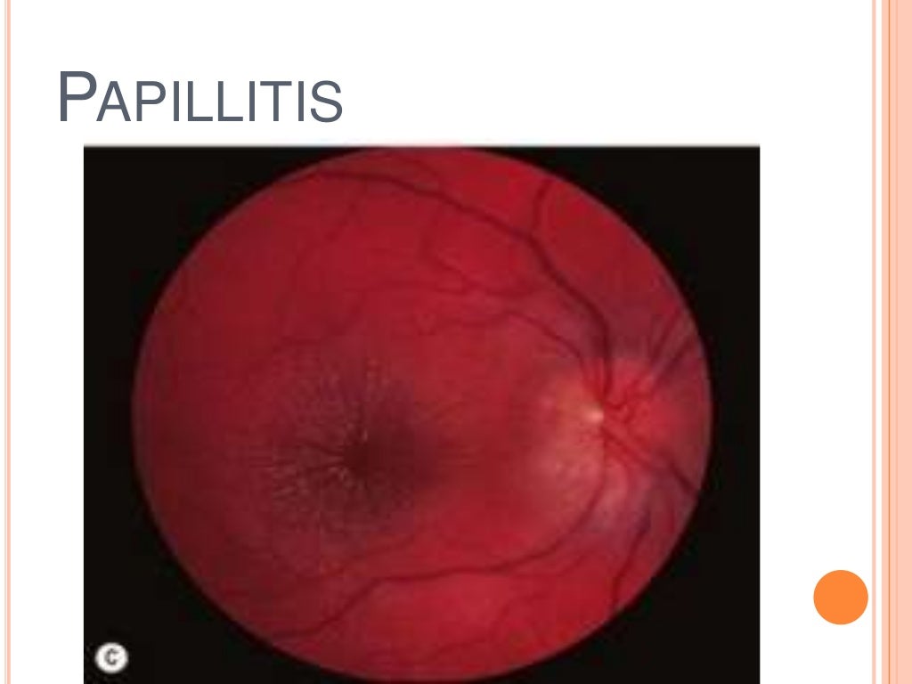 Anterior uveitis