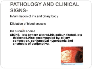 PATHOLOGY AND CLINICAL
SIGNS-
Inflammation of iris and ciliary body
Dilatation of blood vessels
Iris stromal edema.
SIGNS - Iris pattern altered.Iris colour altered. Iris
thickened.Also accompanied by, ciliary
congestion, conjunctival hyperaemia and
chemosis of conjunctiva.
 