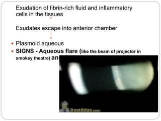 Exudation of fibrin-rich fluid and inflammatory
cells in the tissues
Exudates escape into anterior chamber
 Plasmoid aqueous
 SIGNS - Aqueous flare (like the beam of projector in
smokey theatre) and Cells
 