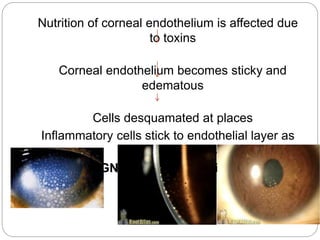 Nutrition of corneal endothelium is affected due
to toxins
Corneal endothelium becomes sticky and
edematous
Cells desquamated at places
Inflammatory cells stick to endothelial layer as
cellular deposits
SIGN – Keratic precipitates
 