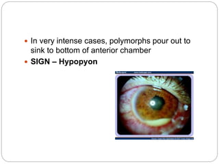  In very intense cases, polymorphs pour out to
sink to bottom of anterior chamber
 SIGN – Hypopyon
 