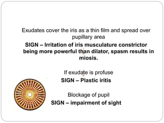 Exudates cover the iris as a thin film and spread over
pupillary area
SIGN – Irritation of iris musculature constrictor
being more powerful than dilator, spasm results in
miosis.
If exudate is profuse
SIGN – Plastic iritis
Blockage of pupil
SIGN – impairment of sight
 