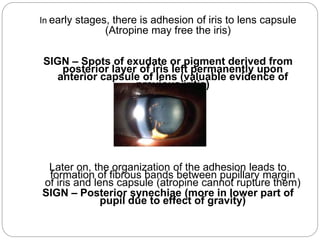 In early stages, there is adhesion of iris to lens capsule
(Atropine may free the iris)
SIGN – Spots of exudate or pigment derived from
posterior layer of iris left permanently upon
anterior capsule of lens (valuable evidence of
previous iritis)
Later on, the organization of the adhesion leads to
formation of fibrous bands between pupillary margin
of iris and lens capsule (atropine cannot rupture them)
SIGN – Posterior synechiae (more in lower part of
pupil due to effect of gravity)
 