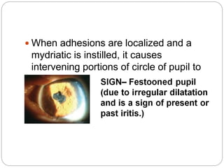  When adhesions are localized and a
mydriatic is instilled, it causes
intervening portions of circle of pupil to
dilate.
 