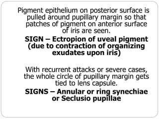 Pigment epithelium on posterior surface is
pulled around pupillary margin so that
patches of pigment on anterior surface
of iris are seen.
SIGN – Ectropion of uveal pigment
(due to contraction of organizing
exudates upon iris)
With recurrent attacks or severe cases,
the whole circle of pupillary margin gets
tied to lens capsule.
SIGNS – Annular or ring synechiae
or Seclusio pupillae
 