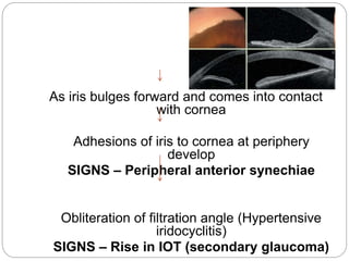 As iris bulges forward and comes into contact
with cornea
Adhesions of iris to cornea at periphery
develop
SIGNS – Peripheral anterior synechiae
Obliteration of filtration angle (Hypertensive
iridocyclitis)
SIGNS – Rise in IOT (secondary glaucoma)
 
