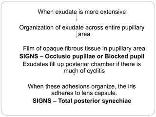 When exudate is more extensive
Organization of exudate across entire pupillary
area
Film of opaque fibrous tissue in pupillary area
SIGNS – Occlusio pupillae or Blocked pupil
Exudates fill up posterior chamber if there is
much of cyclitis
When these adhesions organize, the iris
adheres to lens capsule.
SIGNS – Total posterior synechiae
 