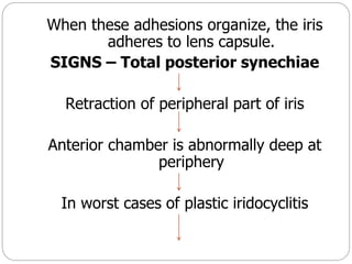 When these adhesions organize, the iris
adheres to lens capsule.
SIGNS – Total posterior synechiae
Retraction of peripheral part of iris
Anterior chamber is abnormally deep at
periphery
In worst cases of plastic iridocyclitis
 