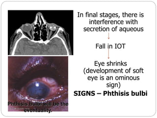 In final stages, there is
interference with
secretion of aqueous
Fall in IOT
Eye shrinks
(development of soft
eye is an ominous
sign)
SIGNS – Phthisis bulbi
 