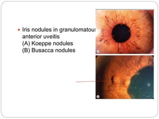  Iris nodules in granulomatous
anterior uveitis
(A) Koeppe nodules
(B) Busacca nodules
 