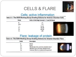 CELLS & FLARE
Cells: active inflammation
Flare: leakage of protein
 