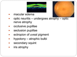  macular edema
 optic neuritis – undergoes atrophy – optic
nerve atrophy
 occlusive pupillae
 seclusion pupillae
 ectropion of uveal pigment
 hypotony – atrophic bulbi
 secondary squint
 iris atrophy
 