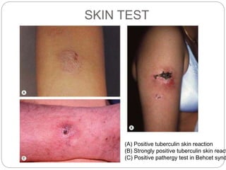 SKIN TEST
(A) Positive tuberculin skin reaction
(B) Strongly positive tuberculin skin react
(C) Positive pathergy test in Behcet synd
 