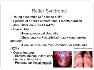 Reiter Syndrome
 Young adult male (3rd decade of life)
 Episode of arthritis of more than 1 month duration
 About 85% are + for HLA-B27
 Classic triad
Non-gonococcal Urethritis
Seronegative Polyarthritis(mostly knee, ankles
and toes)
Conjunctivitis (the most common) or acute iritis
(12%)
 Ocular features
- Bilateral mucopurulent conjunctivitis
- Acute anterior iritis
- Punctate epithelial keratitis
Keratoderma blenorhagica
Circinate balanitis
 