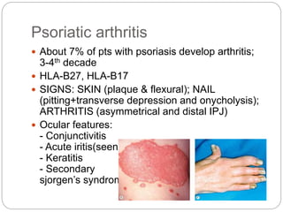 Psoriatic arthritis
 About 7% of pts with psoriasis develop arthritis;
3-4th decade
 HLA-B27, HLA-B17
 SIGNS: SKIN (plaque & flexural); NAIL
(pitting+transverse depression and onycholysis);
ARTHRITIS (asymmetrical and distal IPJ)
 Ocular features:
- Conjunctivitis
- Acute iritis(seen in 7%)
- Keratitis
- Secondary
sjorgen’s syndrome
 