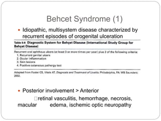 Behcet Syndrome (1)
 Idiopathic, multisystem disease characterized by
recurrent episodes of orogenital ulceration
Generalized occlusive vasculitis
 Posterior involvement > Anterior
retinal vasculitis, hemorrhage, necrosis,
macular edema, ischemic optic neuropathy
 