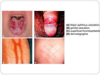 (A) Major aphthous ulceration;
(B) genital ulceration;
(C) superficial thrombophlebitis
(D) dermatographia
 