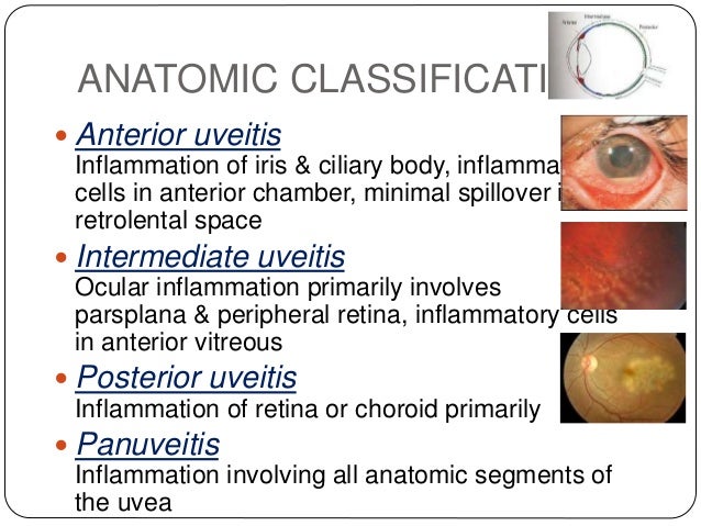 Anterior Uveitis