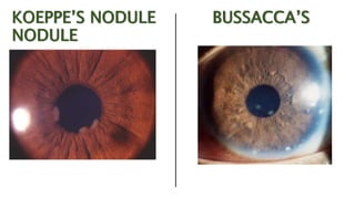 Anterior UVEitis.pptx