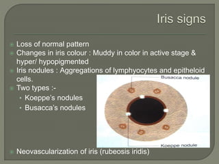 Anterior uveitis.pptx