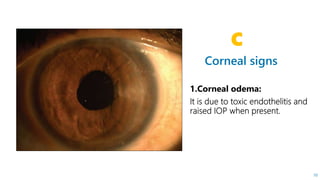 Corneal signs
C
10
 